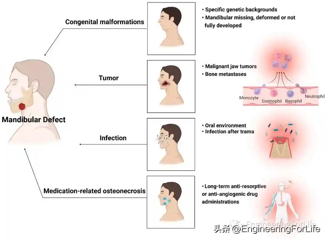 《Bioactive Materials》综述：水凝胶系统用于下颌骨重建