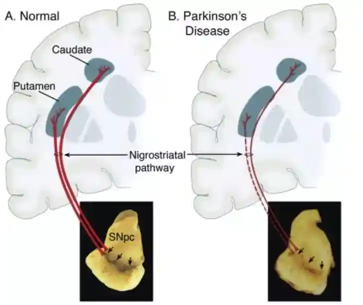 帕金森病治疗的新希望——干细胞