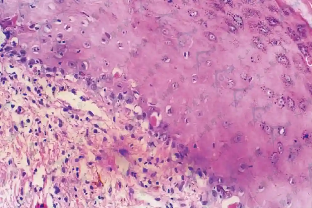 激素治疗白血病或其他肿瘤移植后并发症不理想，干细胞治疗现曙光