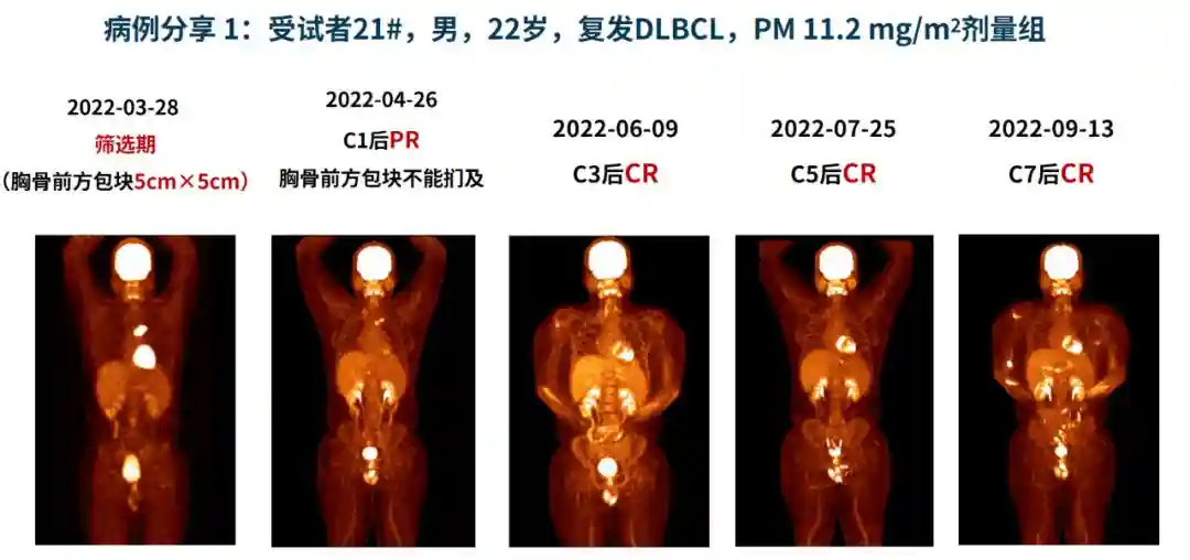 牛挺教授团队：甲磺酸普依司他在复发难治性淋巴瘤治疗中的全面解析丨中华医学会第二次全国淋巴细胞疾病学术大会